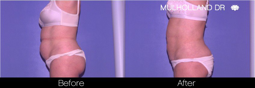 Tumescent Liposuction - Before and After Gallery – Photo 48