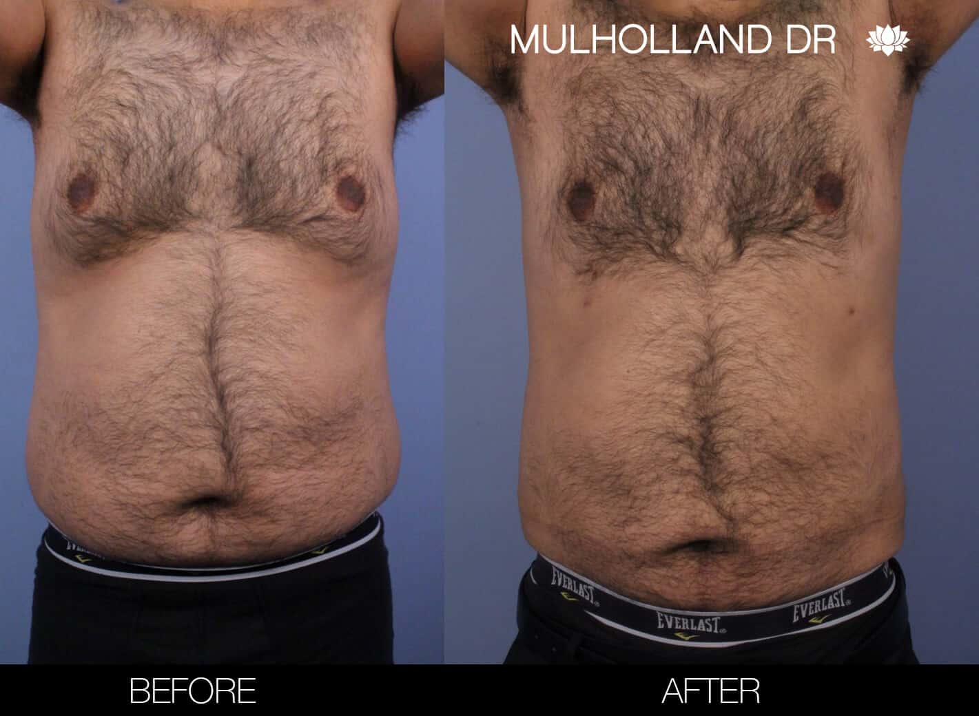 Male Tummy Tuck (Belt Lipectomy) - Before and After Gallery – Photo 48