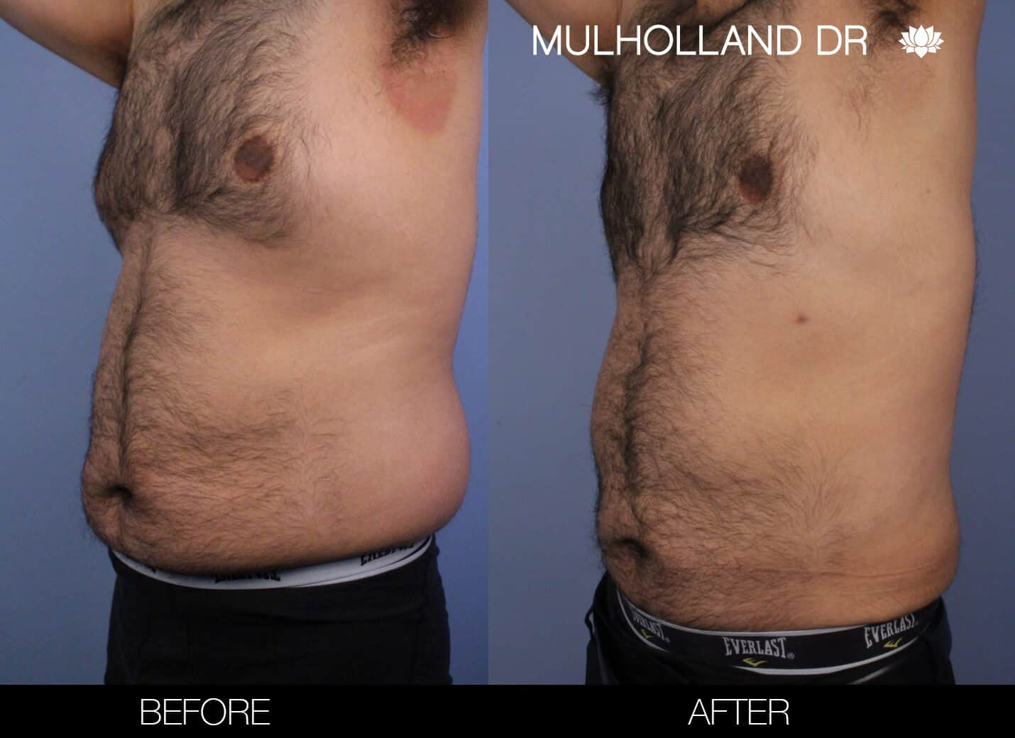 Male Tummy Tuck (Belt Lipectomy) - Before and After Gallery – Photo 49