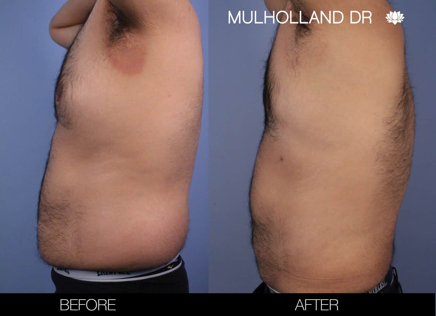 Male Tummy Tuck (Belt Lipectomy) - Before and After Gallery – Photo 50