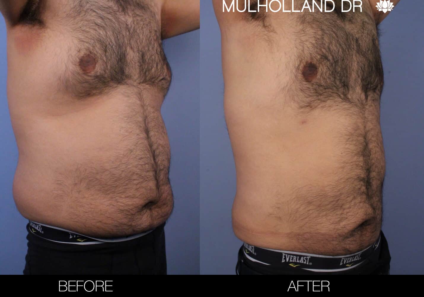 Male Tummy Tuck (Belt Lipectomy) - Before and After Gallery – Photo 51