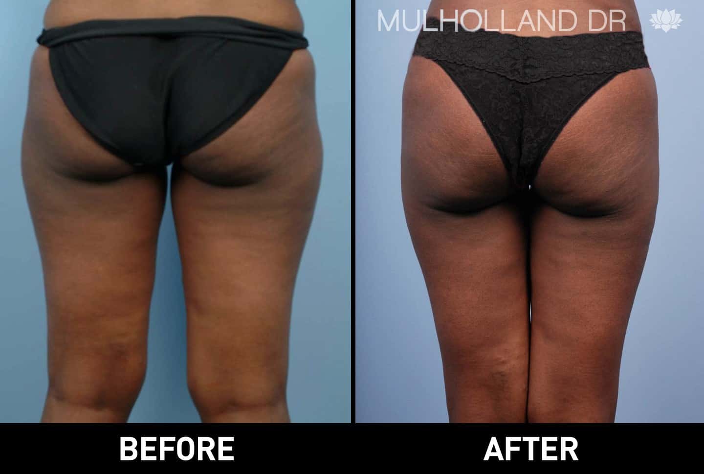 Tumescent Liposuction - Before and After Gallery – Photo 13