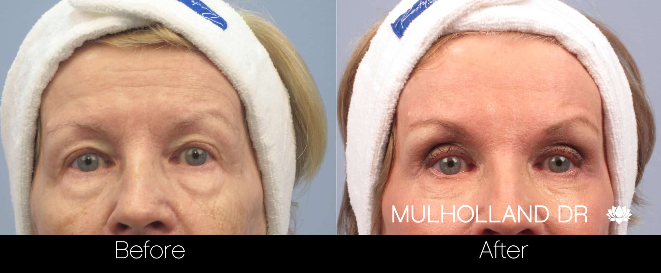 Brow Lift - Before and After Gallery – Photo 50