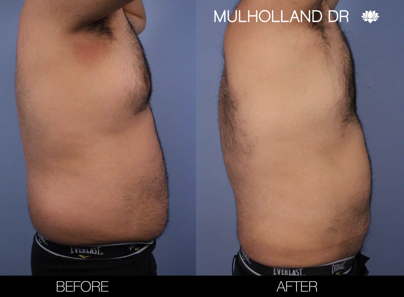 Male Tummy Tuck (Belt Lipectomy) - Before and After Gallery – Photo 52