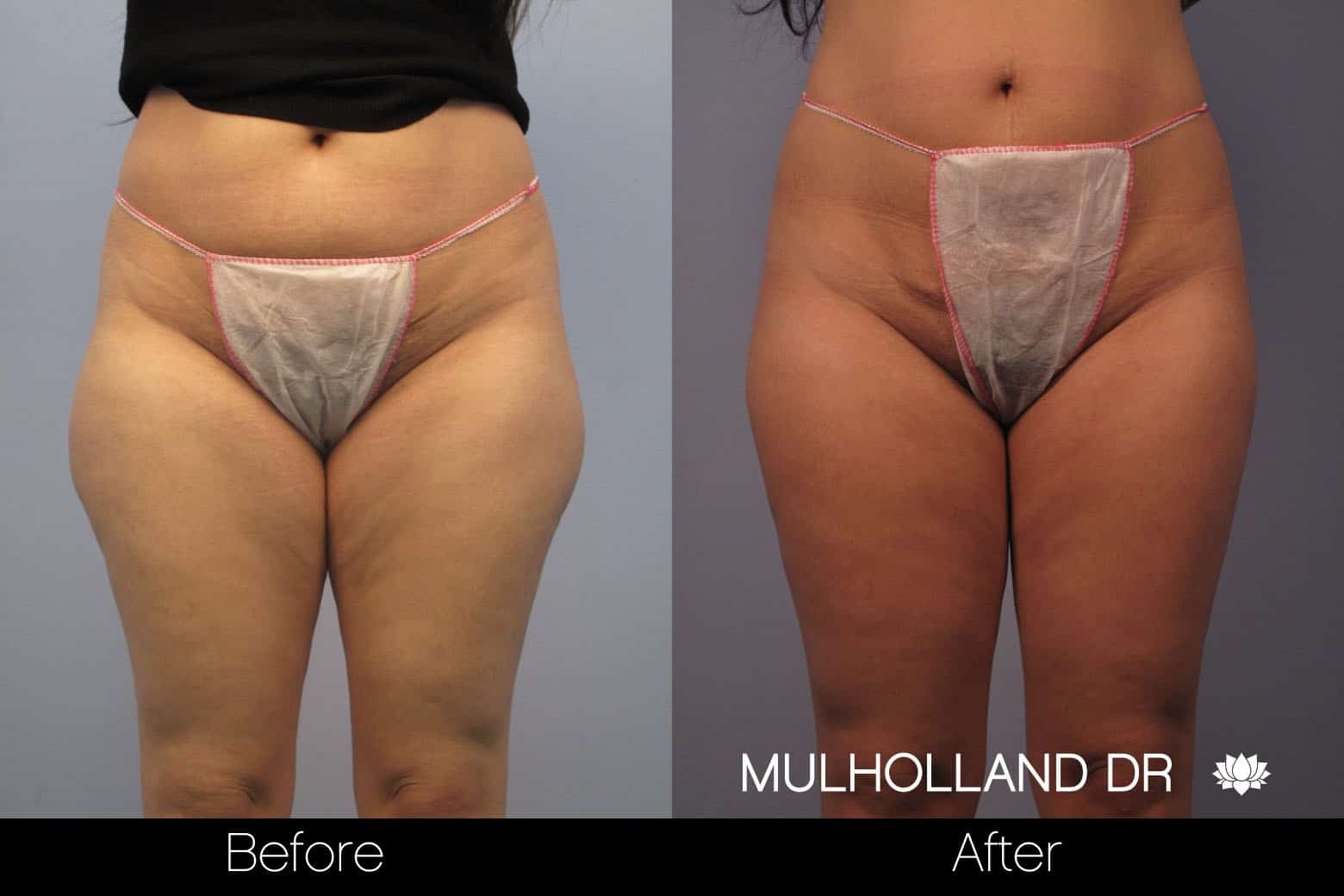 Tumescent Liposuction - Before and After Gallery – Photo 51