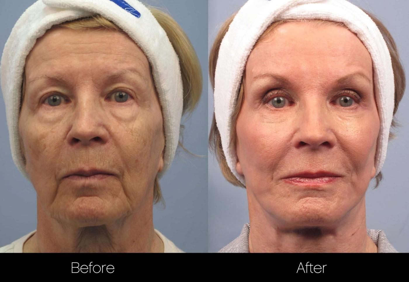 Facial Resurfacing: The Celebrity Skin Secret Revealed - 5u14lav