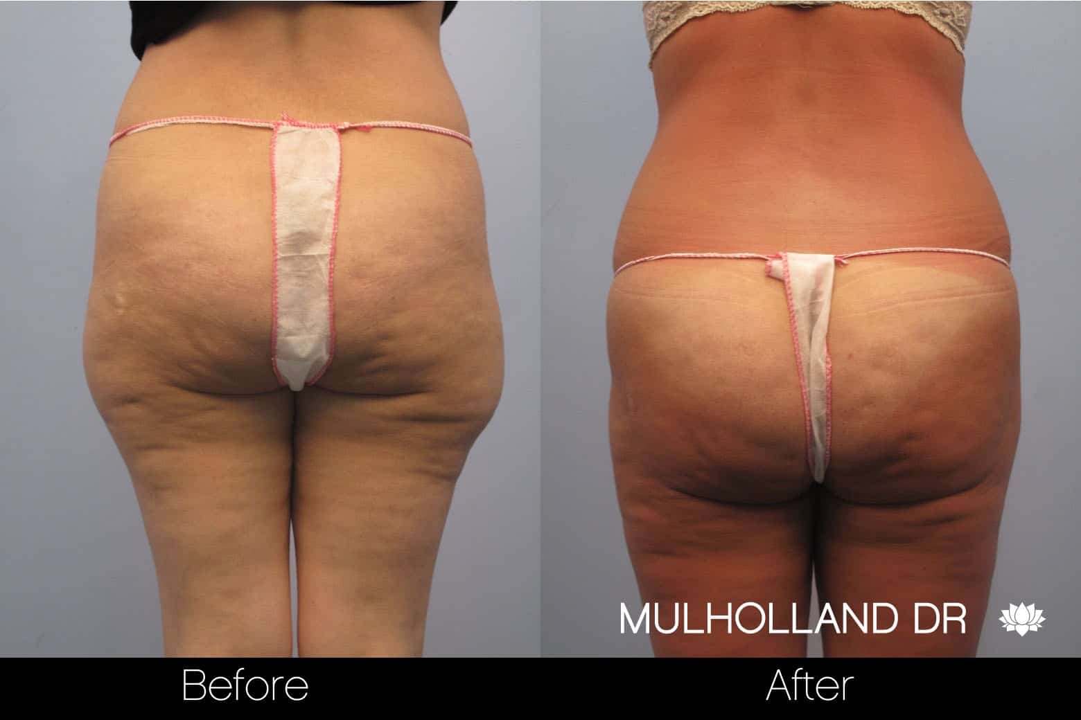 Tumescent Liposuction - Before and After Gallery – Photo 52