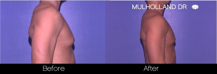 Tumescent Liposuction - Before and After Gallery – Photo 74