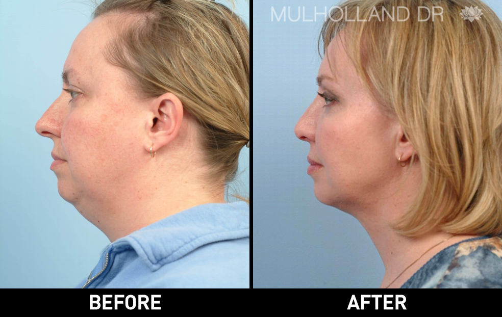 Tumescent Liposuction - Before and After Gallery – Photo 92