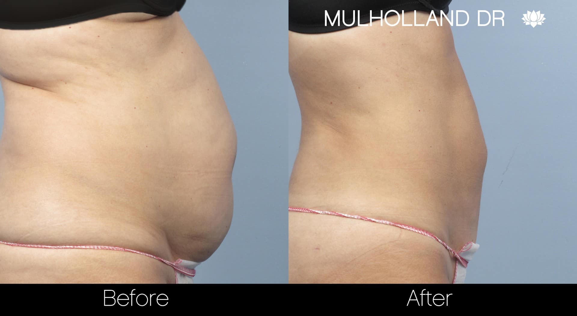 Tumescent Liposuction - Before and After Gallery – Photo 9