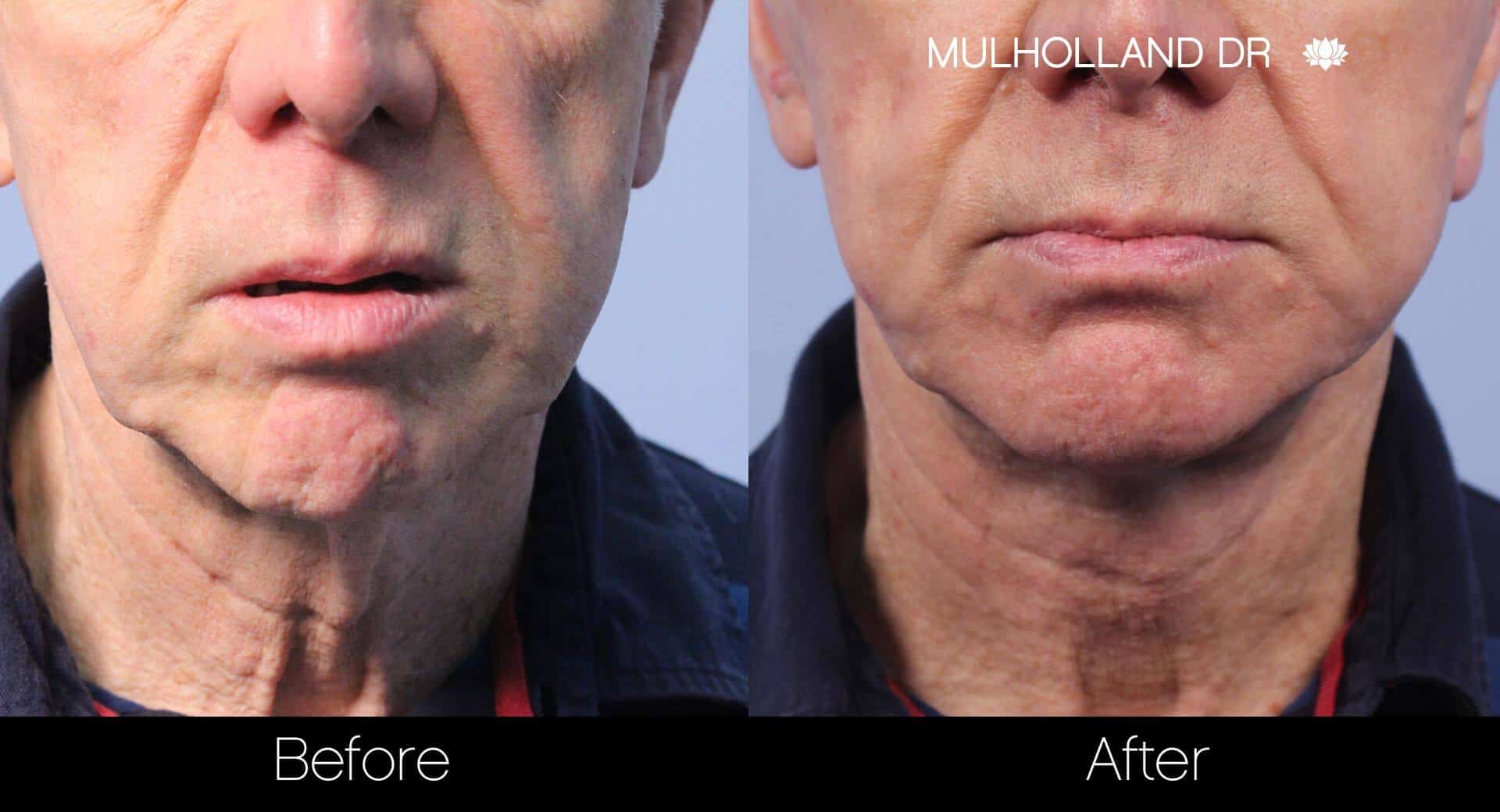 Neck Lift- Before and After Gallery – Photo 113