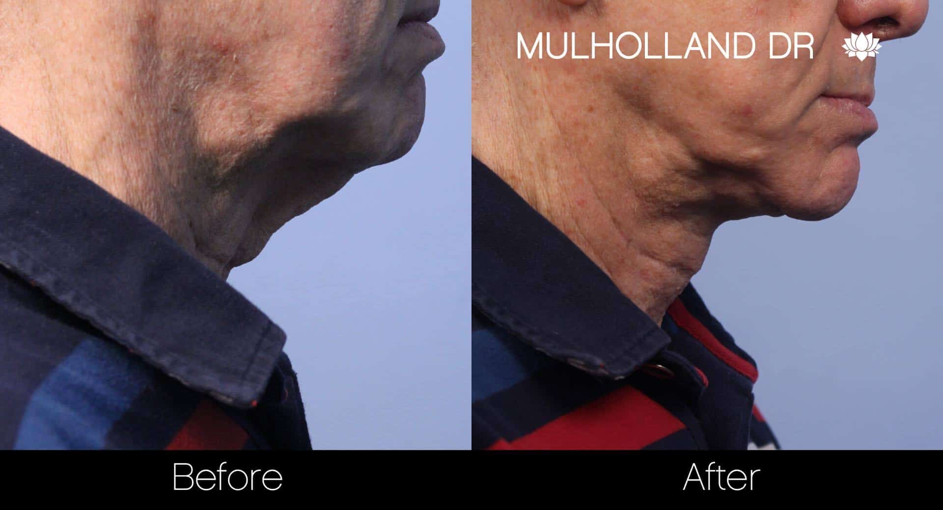 Neck Lift- Before and After Gallery – Photo 117