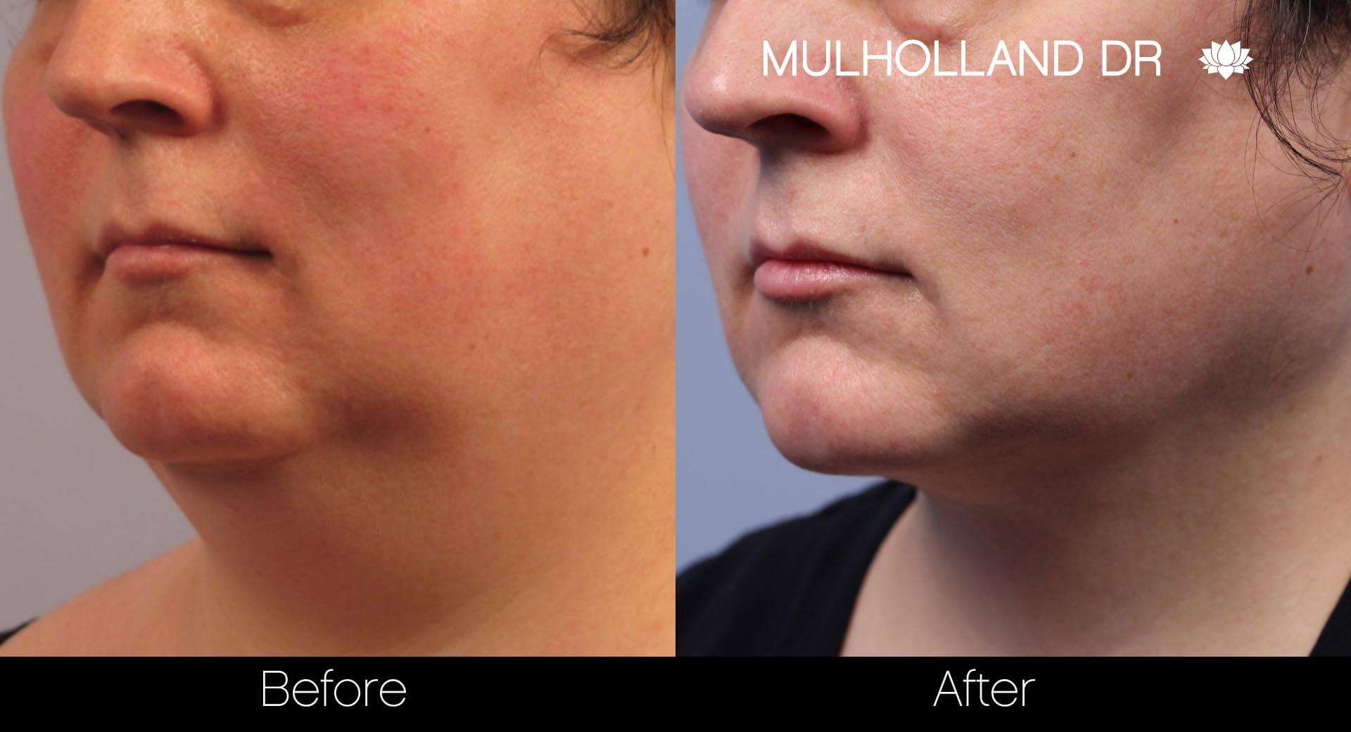 Neck Lift- Before and After Gallery – Photo 19