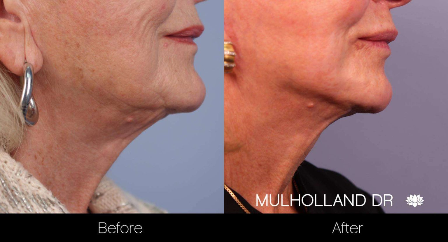Toronto Neck Lift & Double Chin Clinic SpaMedica