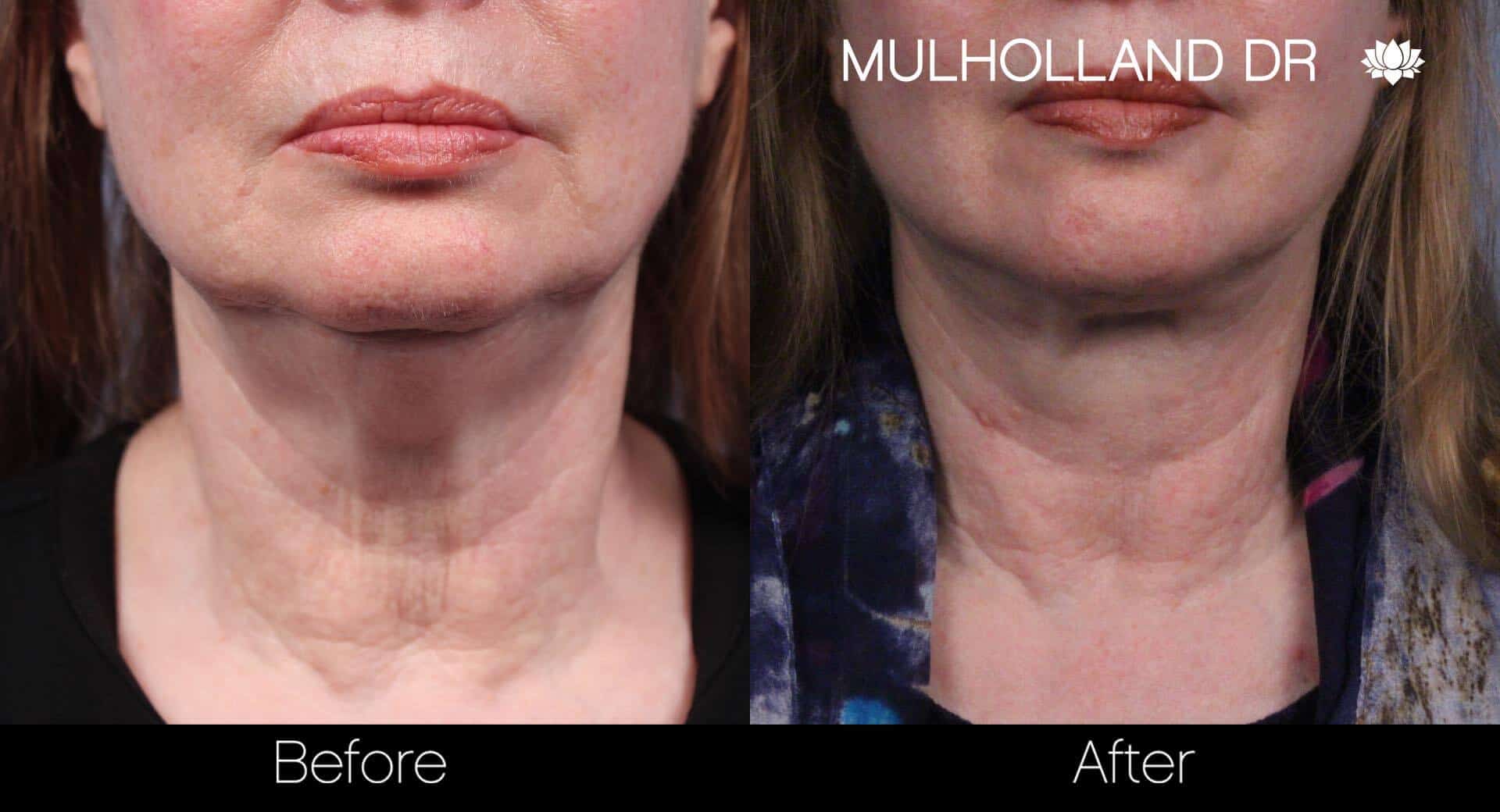 Neck Lift- Before and After Gallery – Photo 37