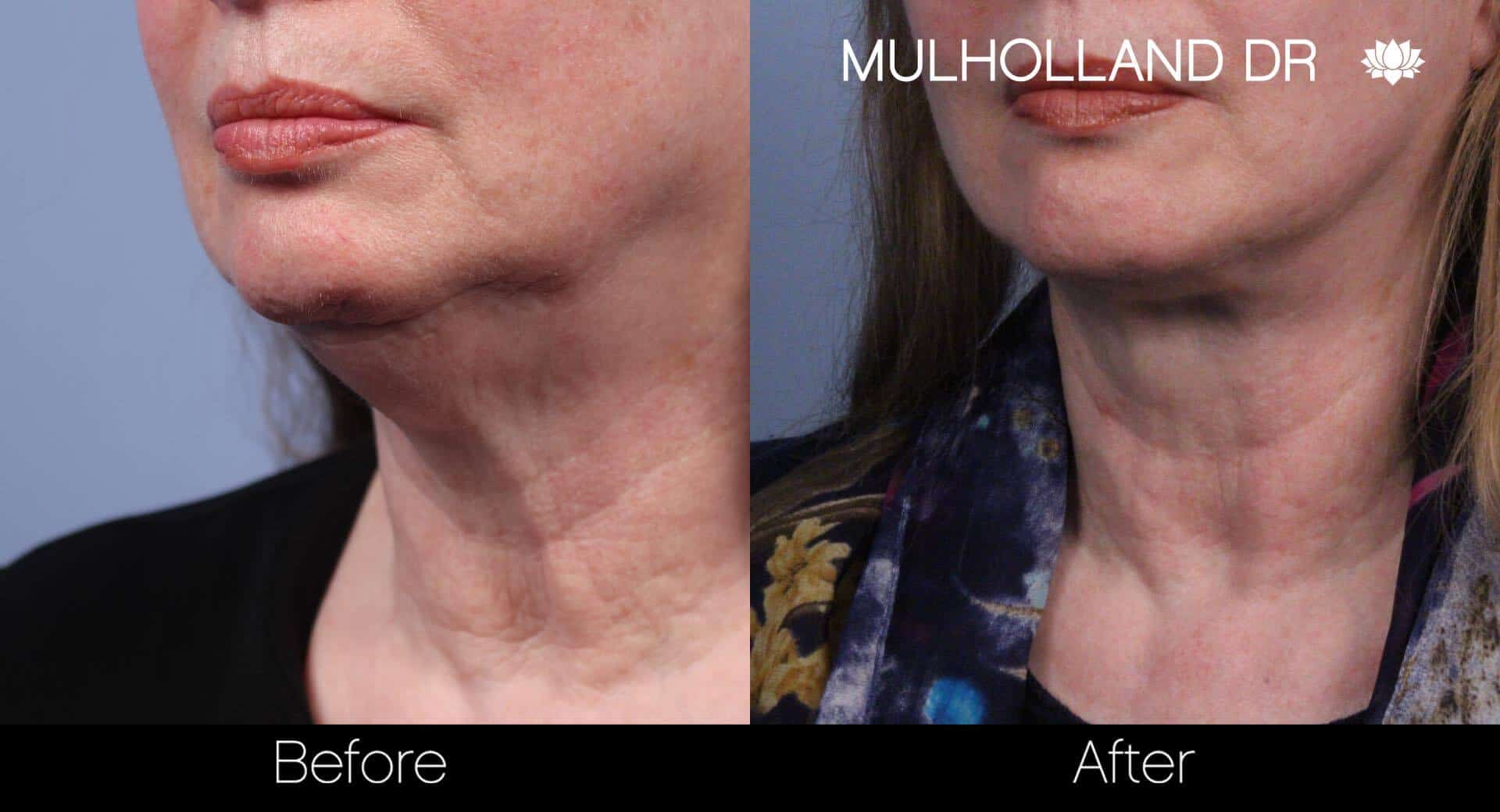 Neck Lift- Before and After Gallery – Photo 38