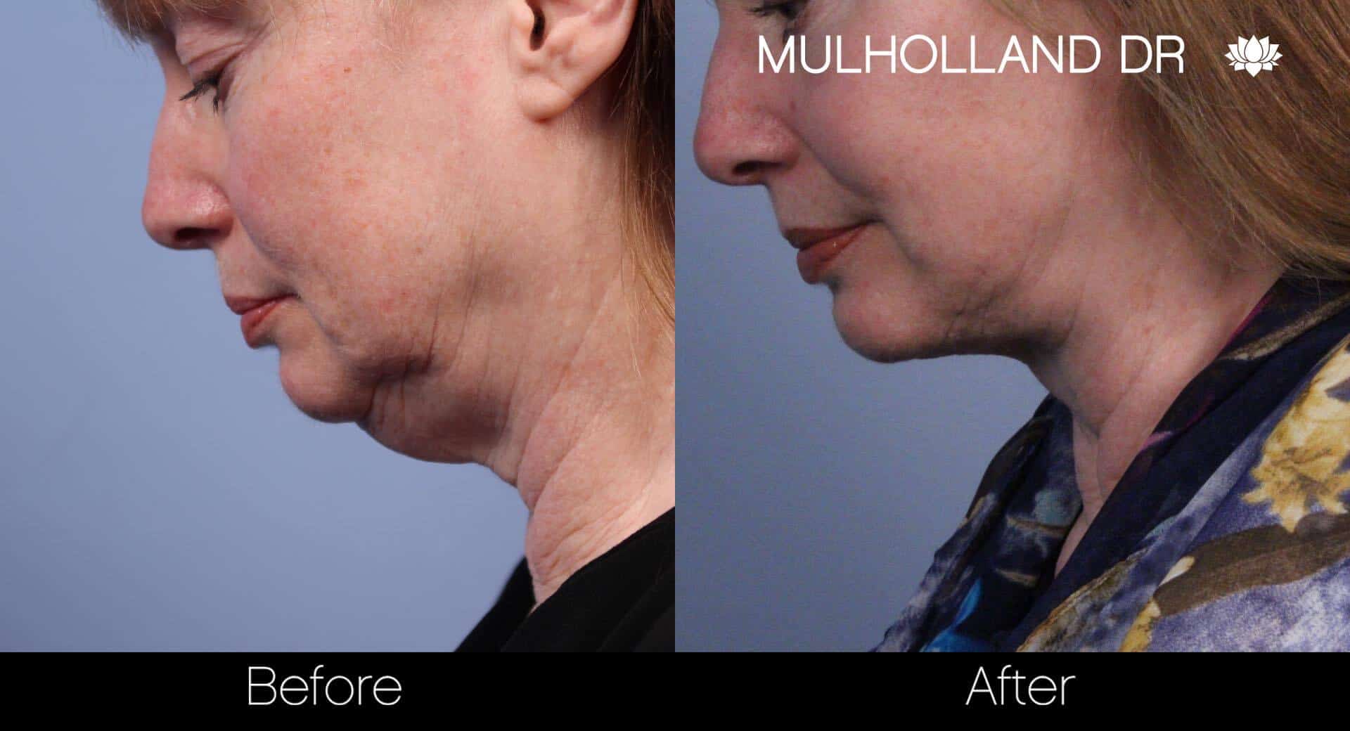 Neck Lift- Before and After Gallery – Photo 40