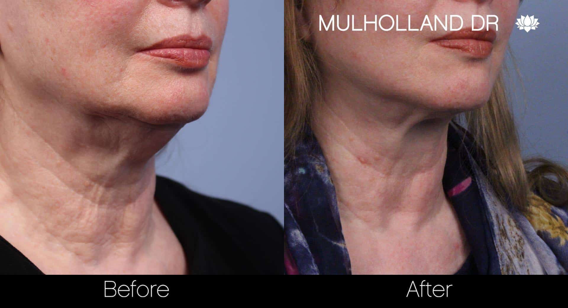 Neck Lift- Before and After Gallery – Photo 41