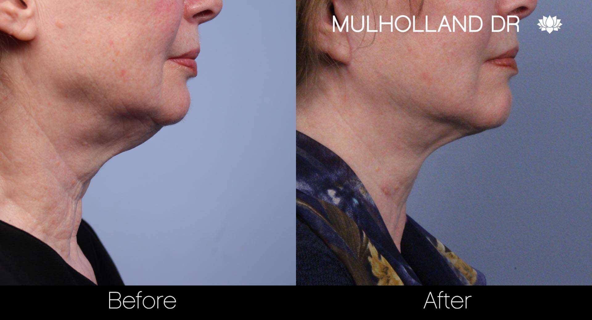Neck Lift- Before and After Gallery – Photo 42