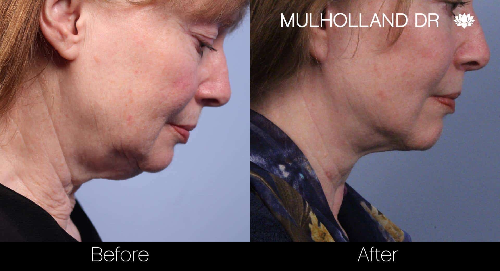 Neck Lift- Before and After Gallery – Photo 43