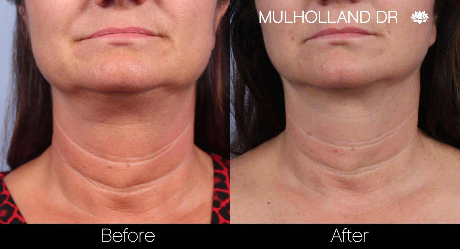 Neck Lift- Before and After Gallery – Photo 44