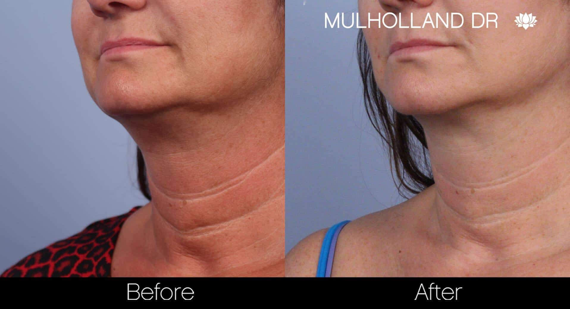 Neck Lift- Before and After Gallery – Photo 45