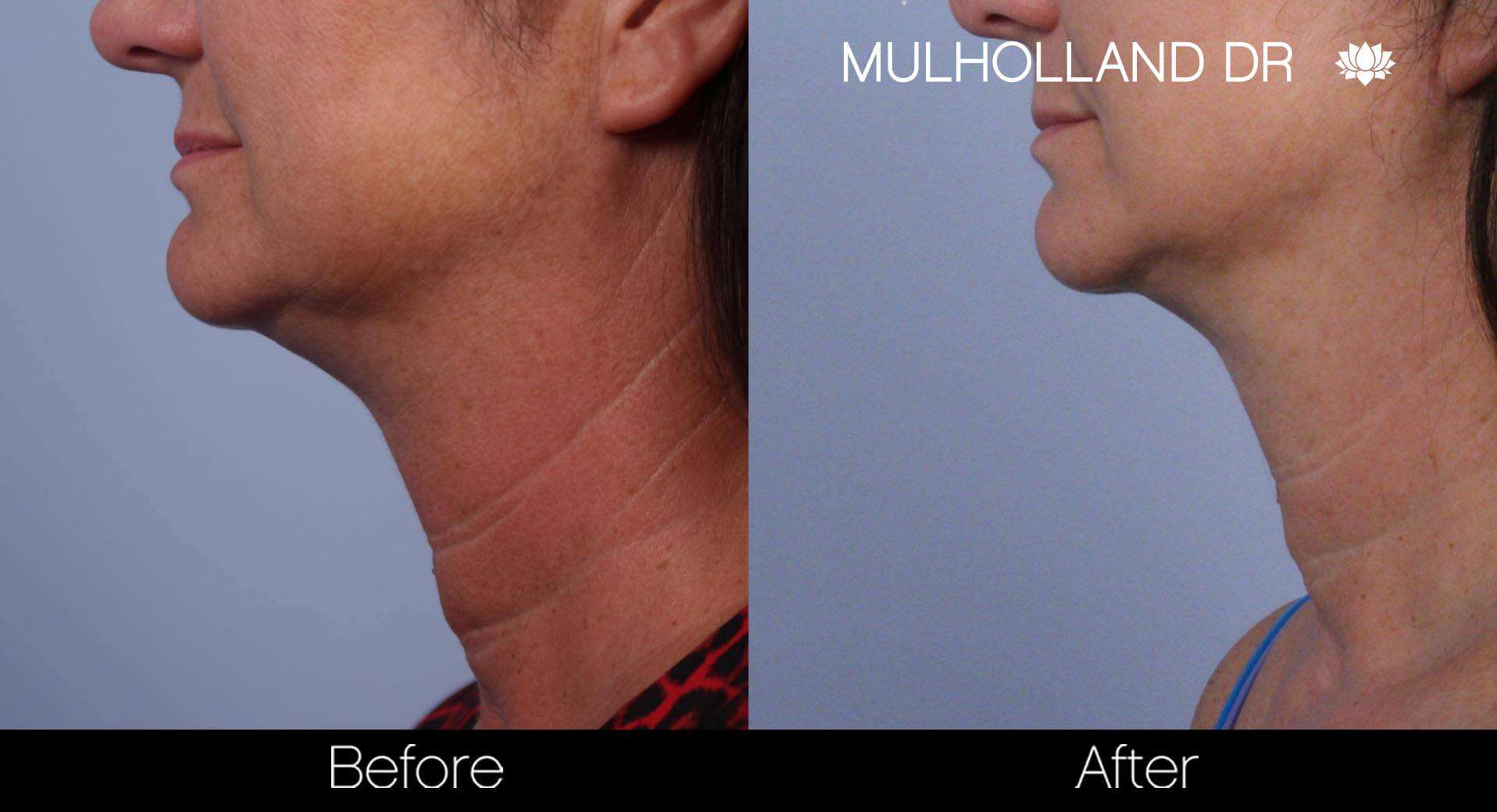 Neck Lift- Before and After Gallery – Photo 46