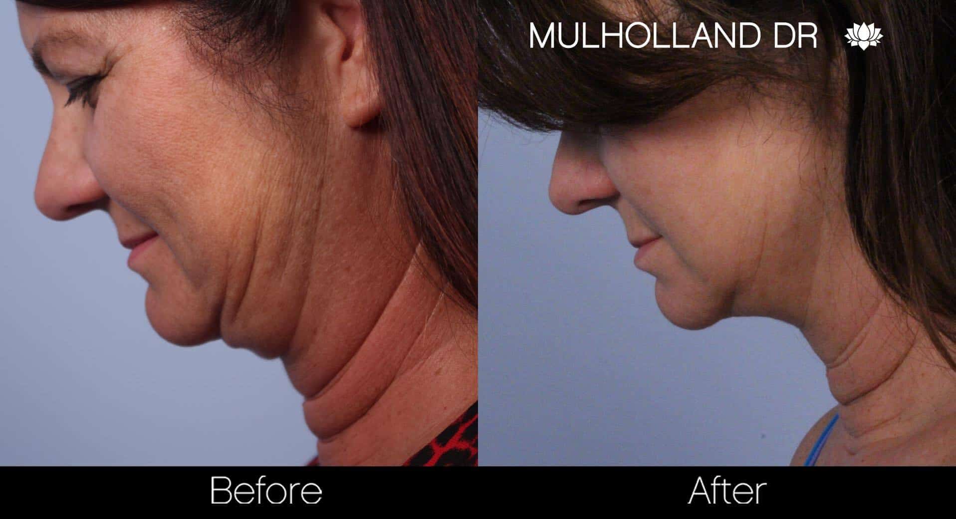 Neck Lift- Before and After Gallery – Photo 47