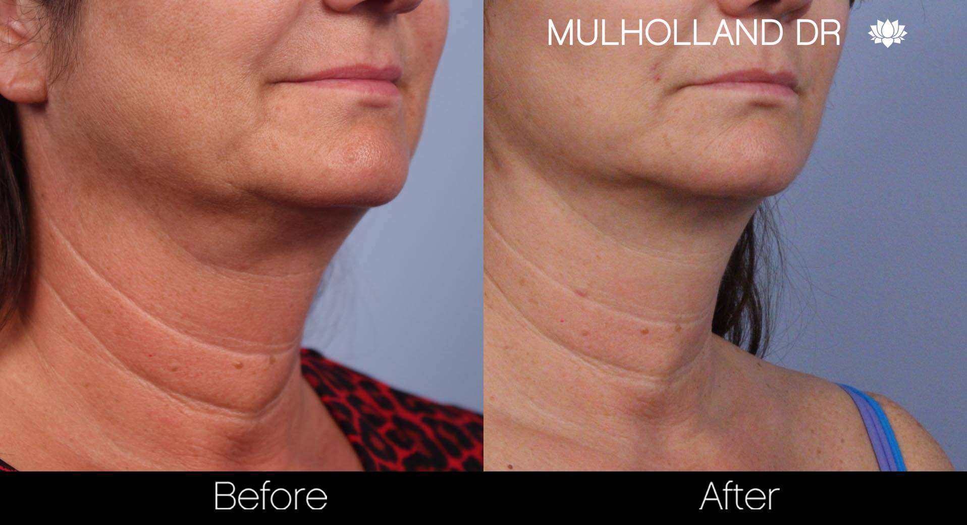 Neck Lift- Before and After Gallery – Photo 48