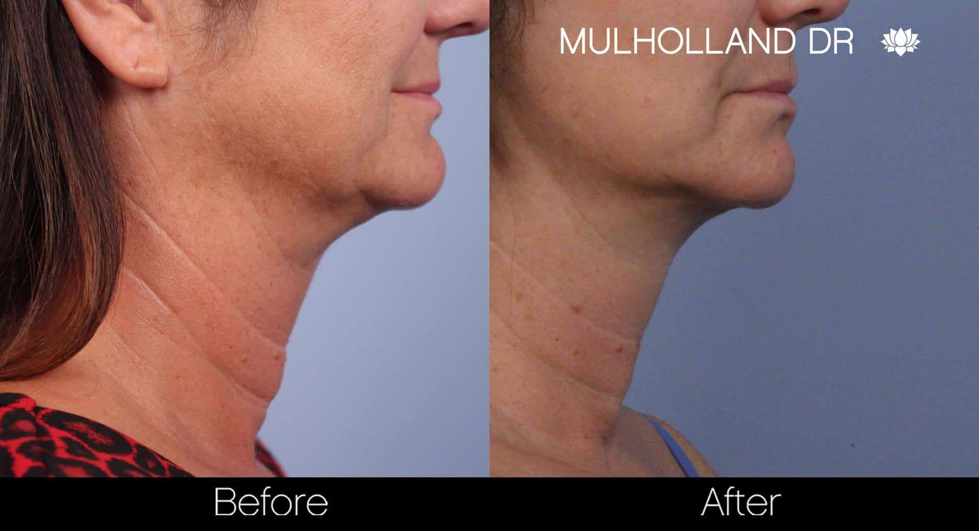 Neck Lift- Before and After Gallery – Photo 49