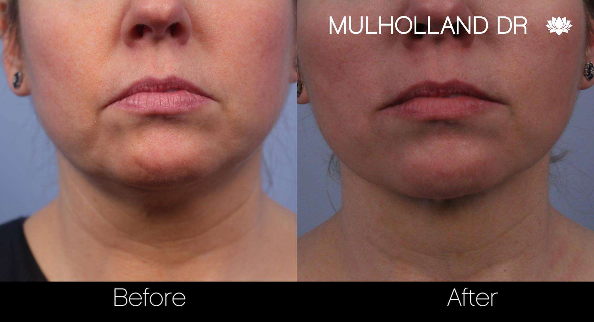 Neck Lift- Before and After Gallery – Photo 50