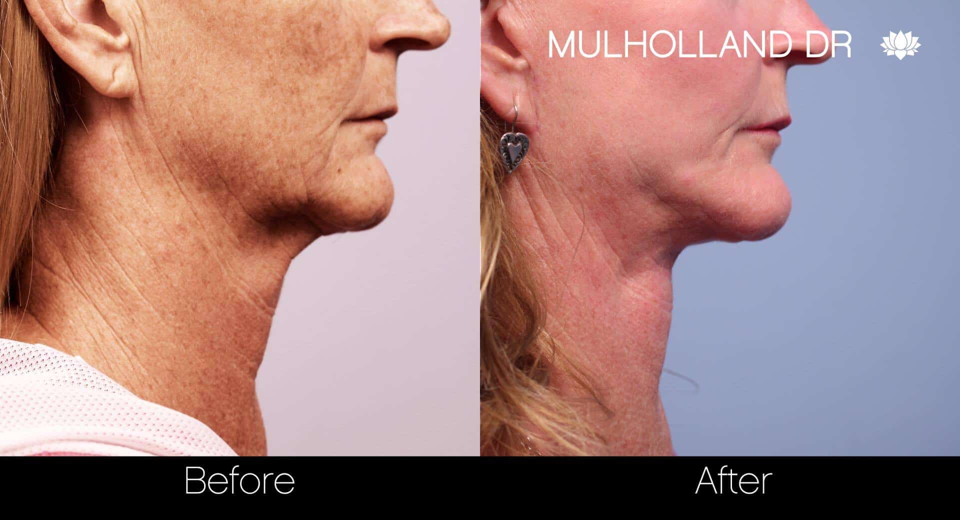Neck Lift- Before and After Gallery – Photo 64