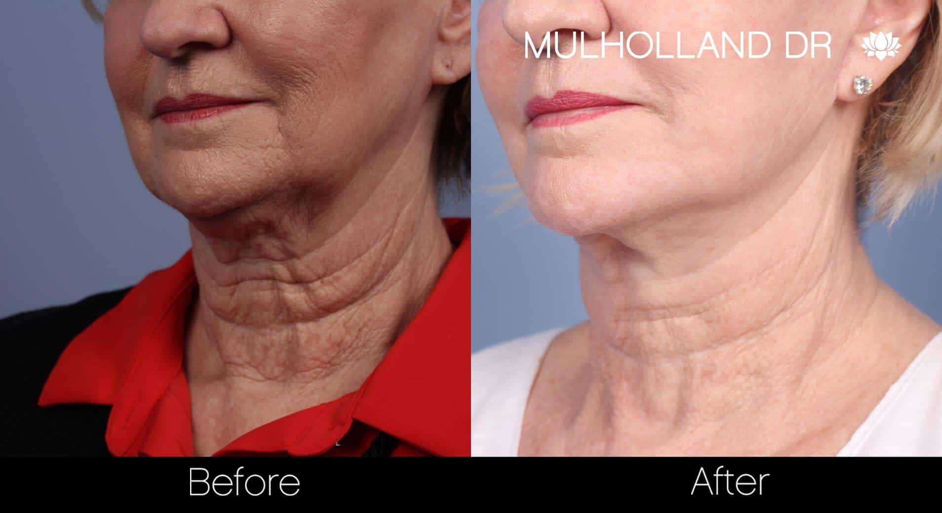 Neck Lift- Before and After Gallery – Photo 67