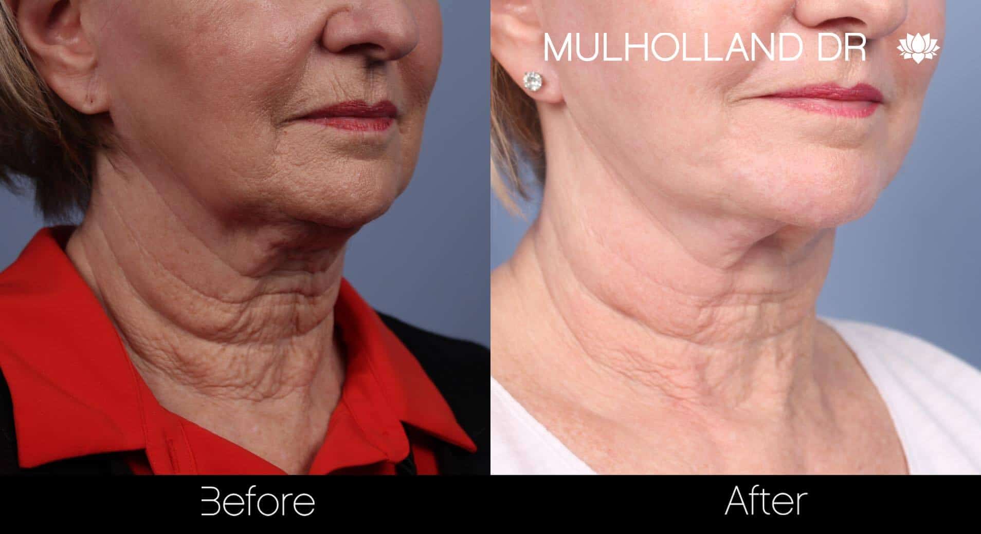 Neck Lift- Before and After Gallery – Photo 68