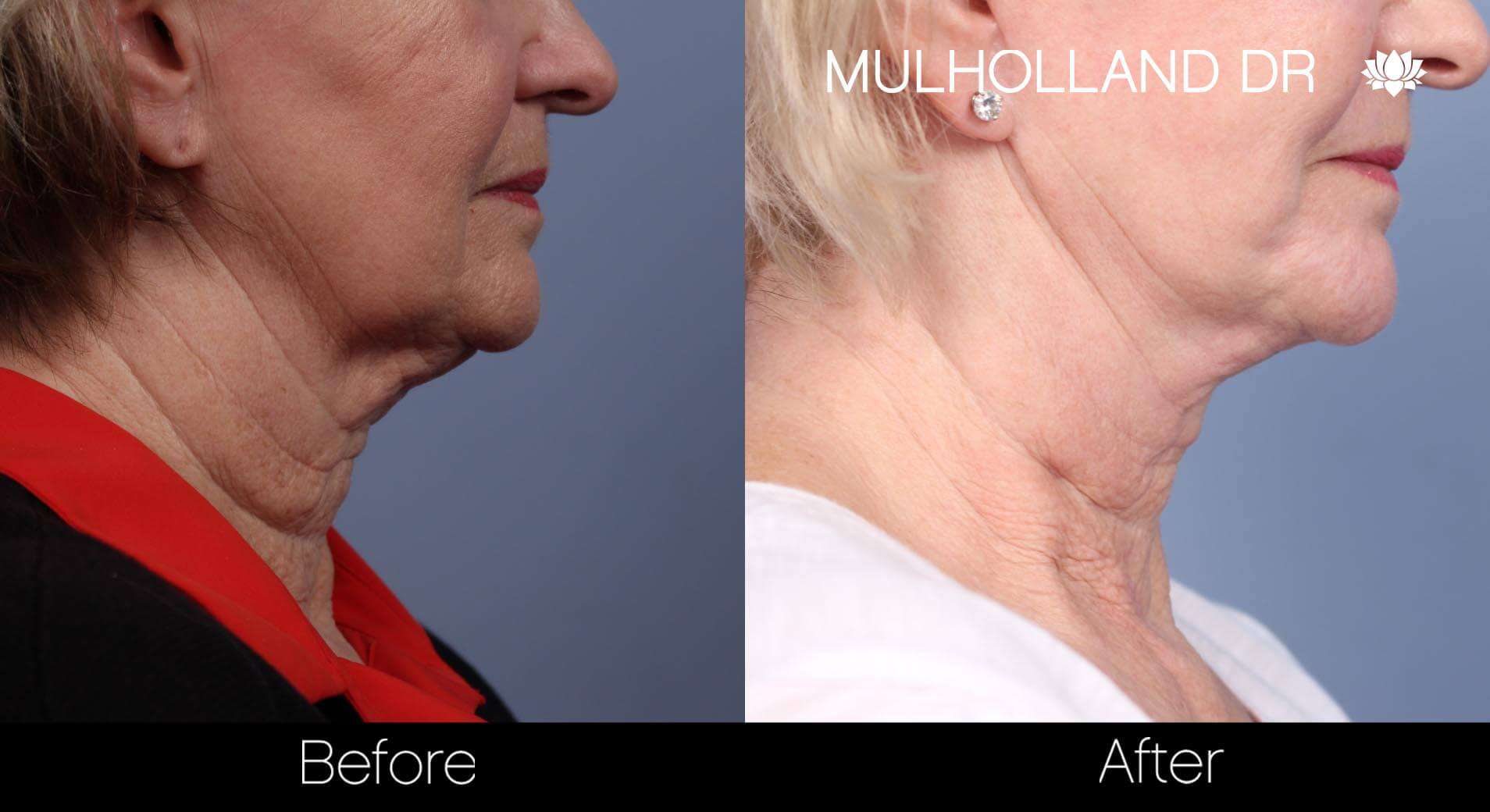 Neck Lift- Before and After Gallery – Photo 69