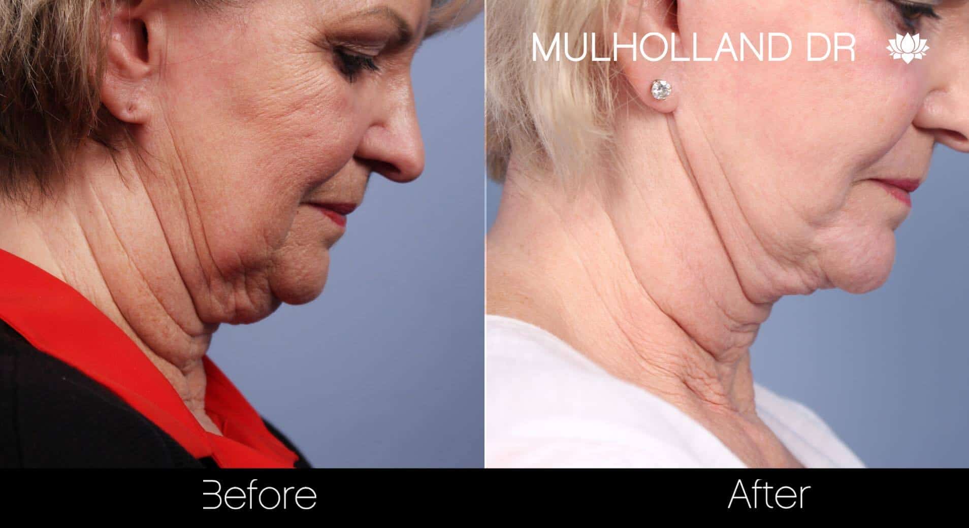 Neck Lift- Before and After Gallery – Photo 70