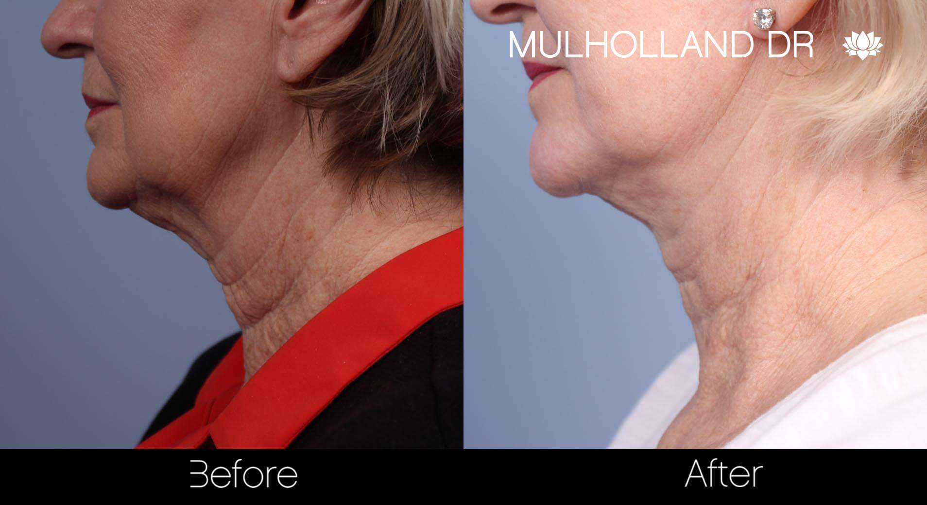 Neck Lift- Before and After Gallery – Photo 71