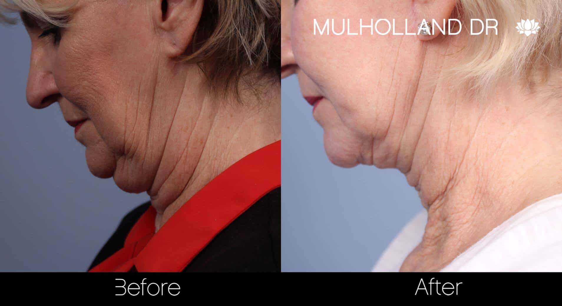 Neck Lift- Before and After Gallery – Photo 72