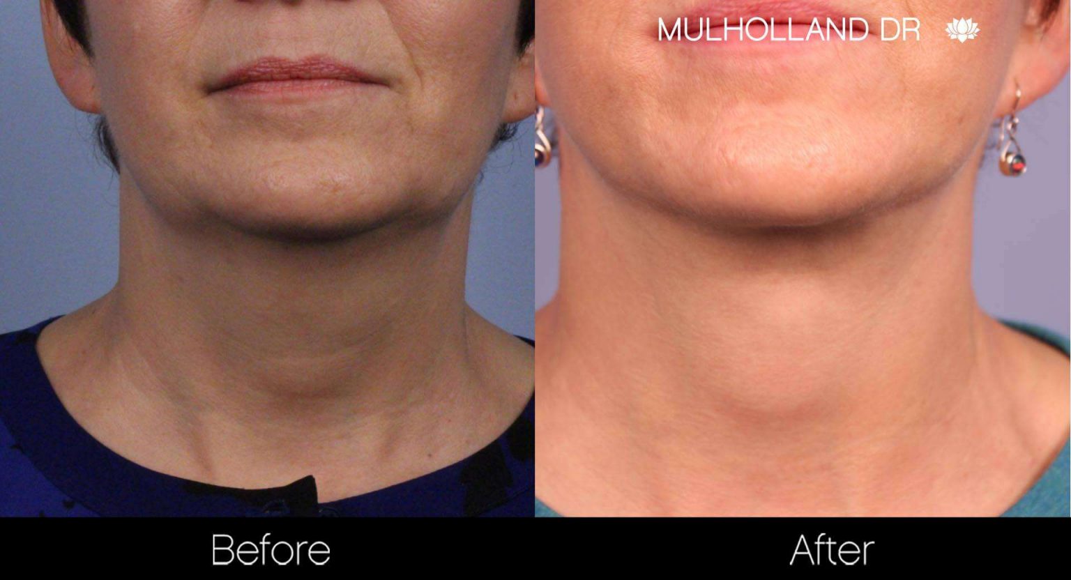 Toronto Neck Lift & Double Chin Clinic SpaMedica