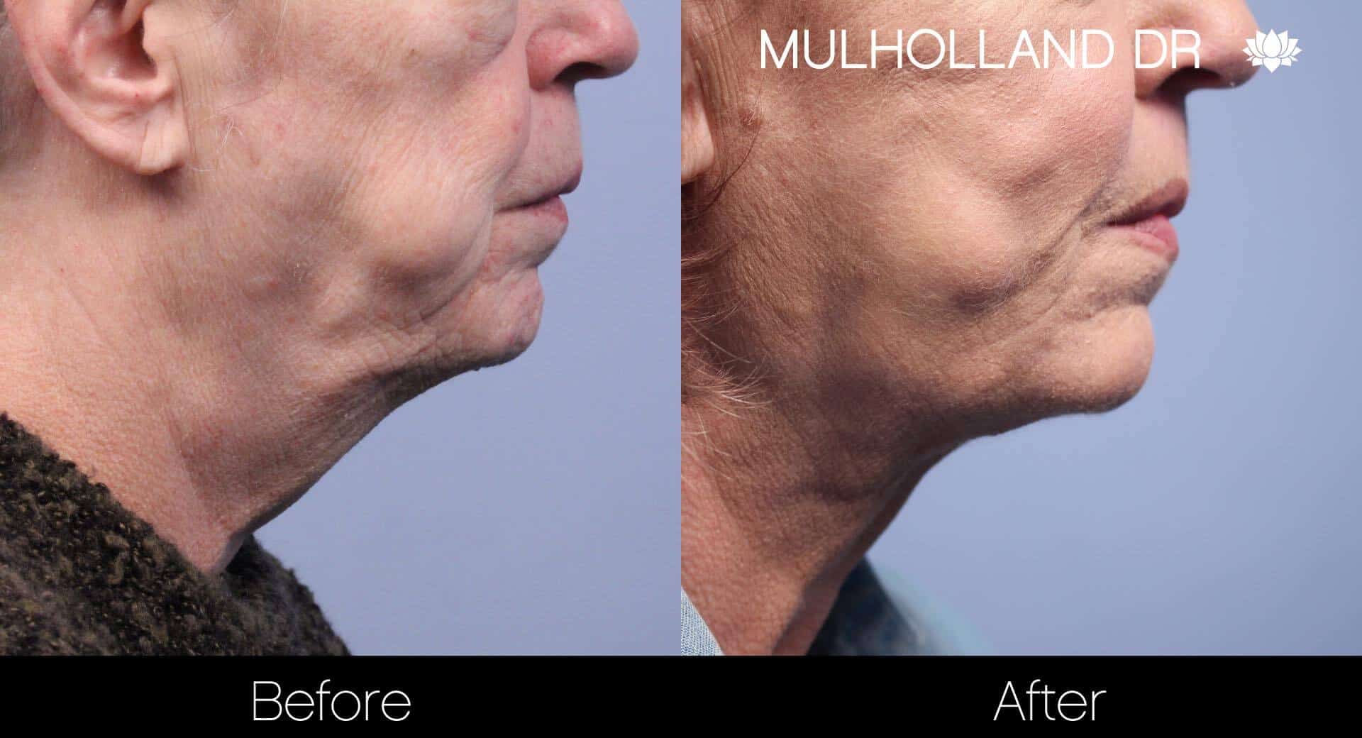 Neck Lift- Before and After Gallery – Photo 79