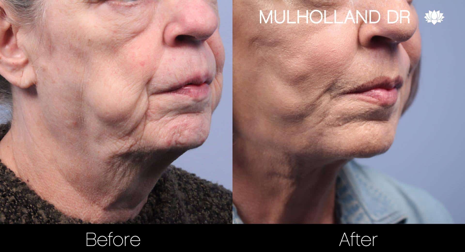 Neck Lift- Before and After Gallery – Photo 80