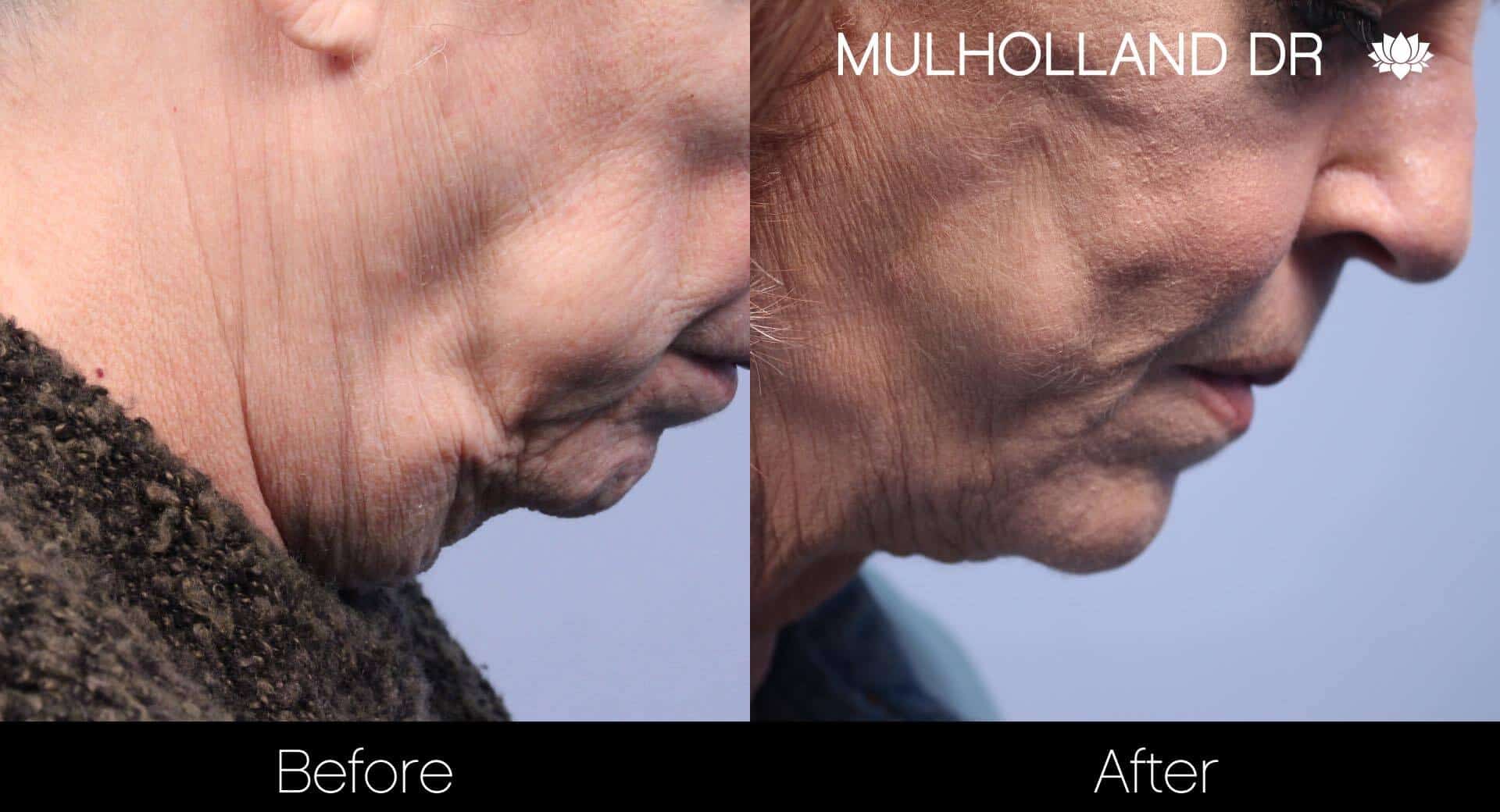 Neck Lift- Before and After Gallery – Photo 81