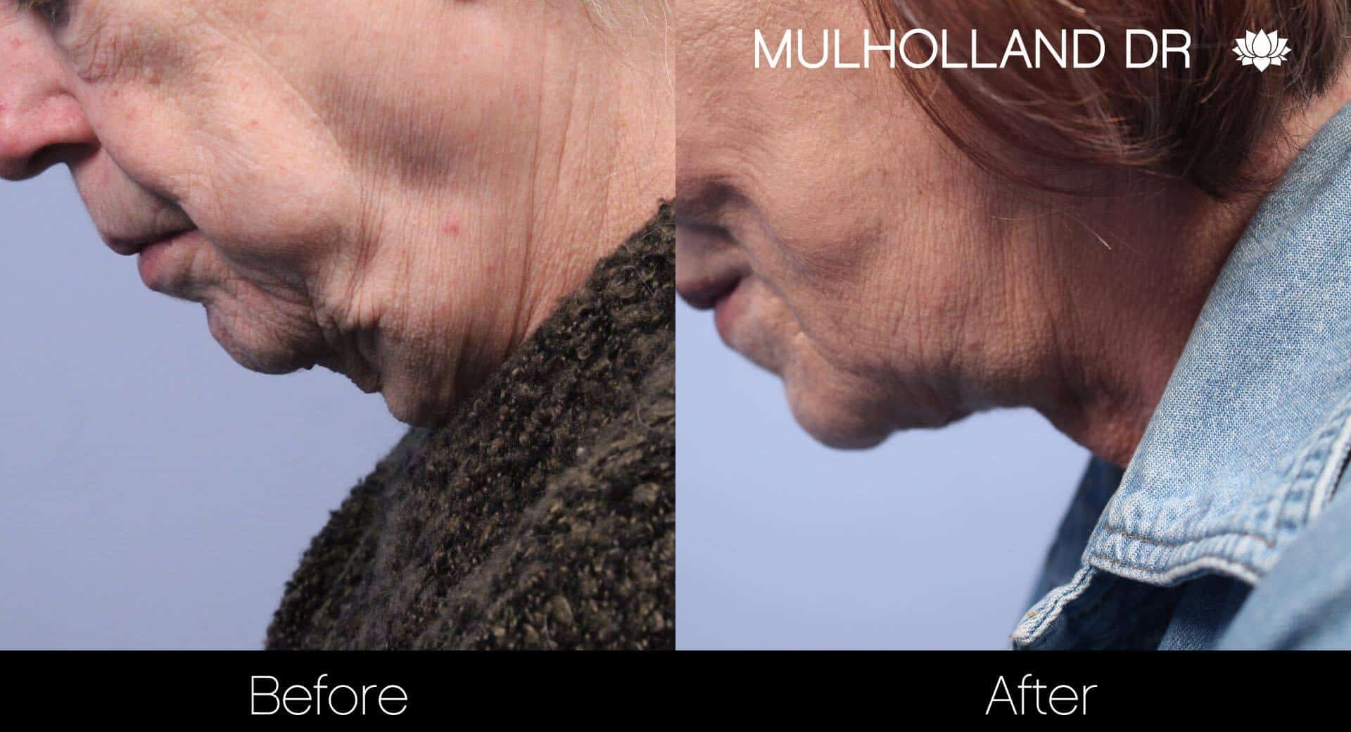 Neck Lift- Before and After Gallery – Photo 82