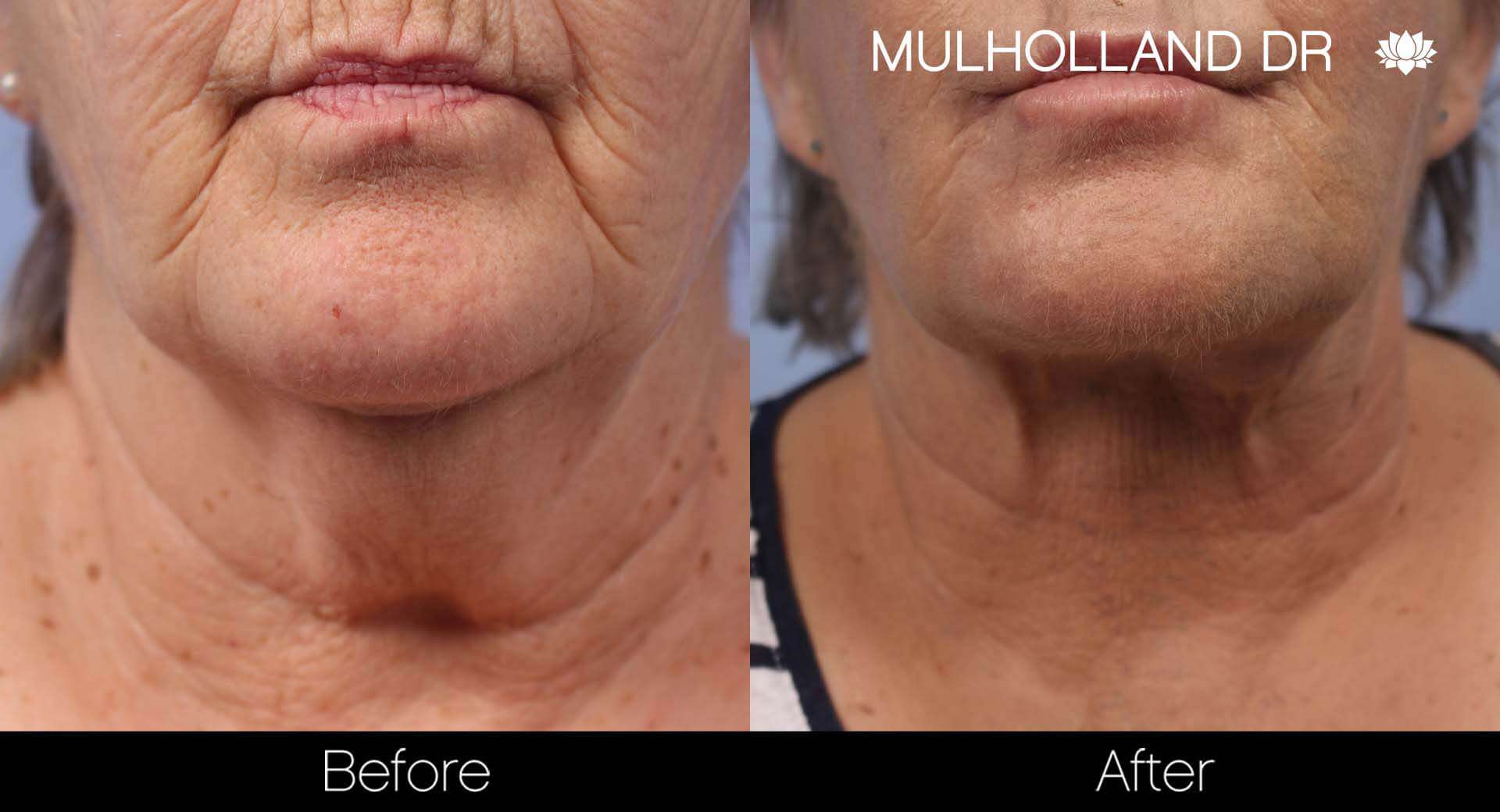 Neck Lift- Before and After Gallery – Photo 84