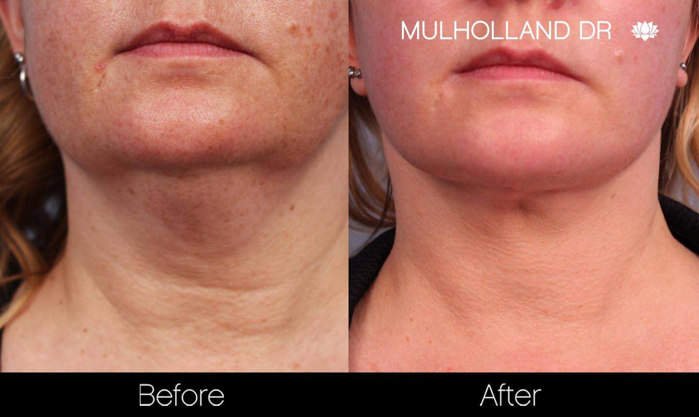 Neck Lift- Before and After Gallery – Photo 89