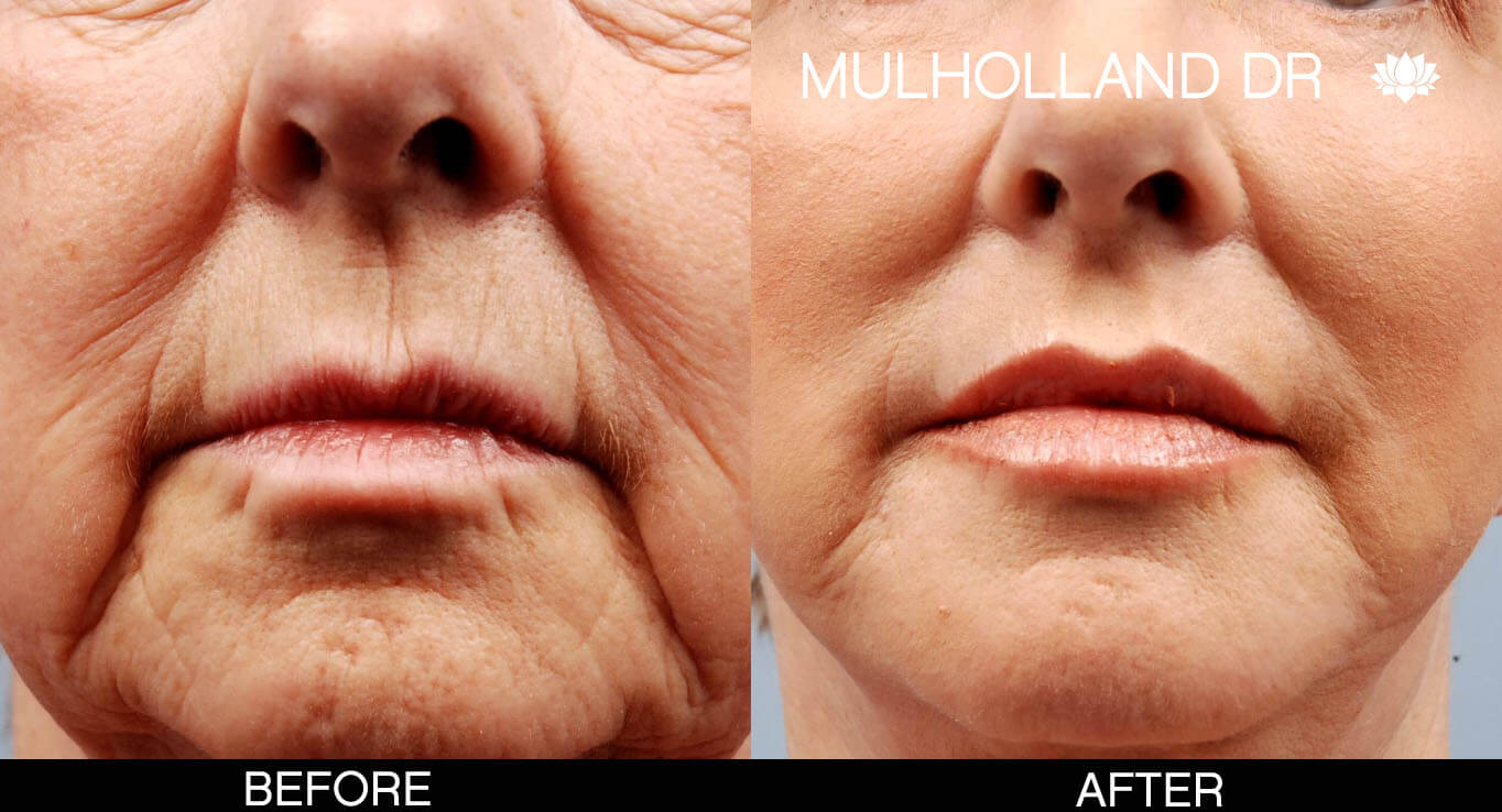 Fractora - Before and After Gallery – Photo 32
