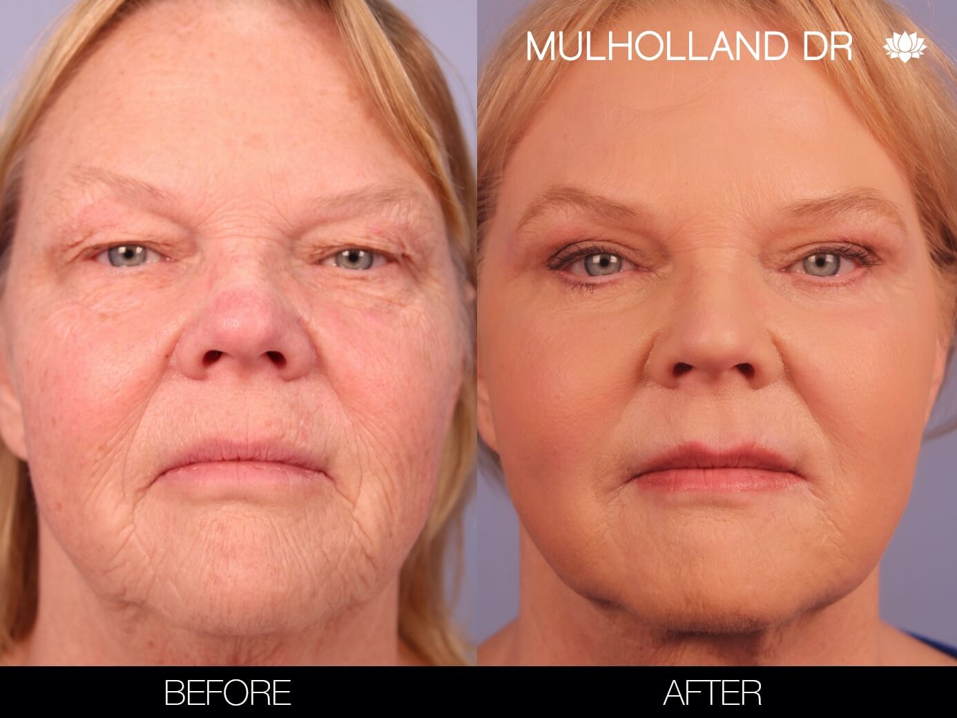 Fractora - Before and After Gallery – Photo 35