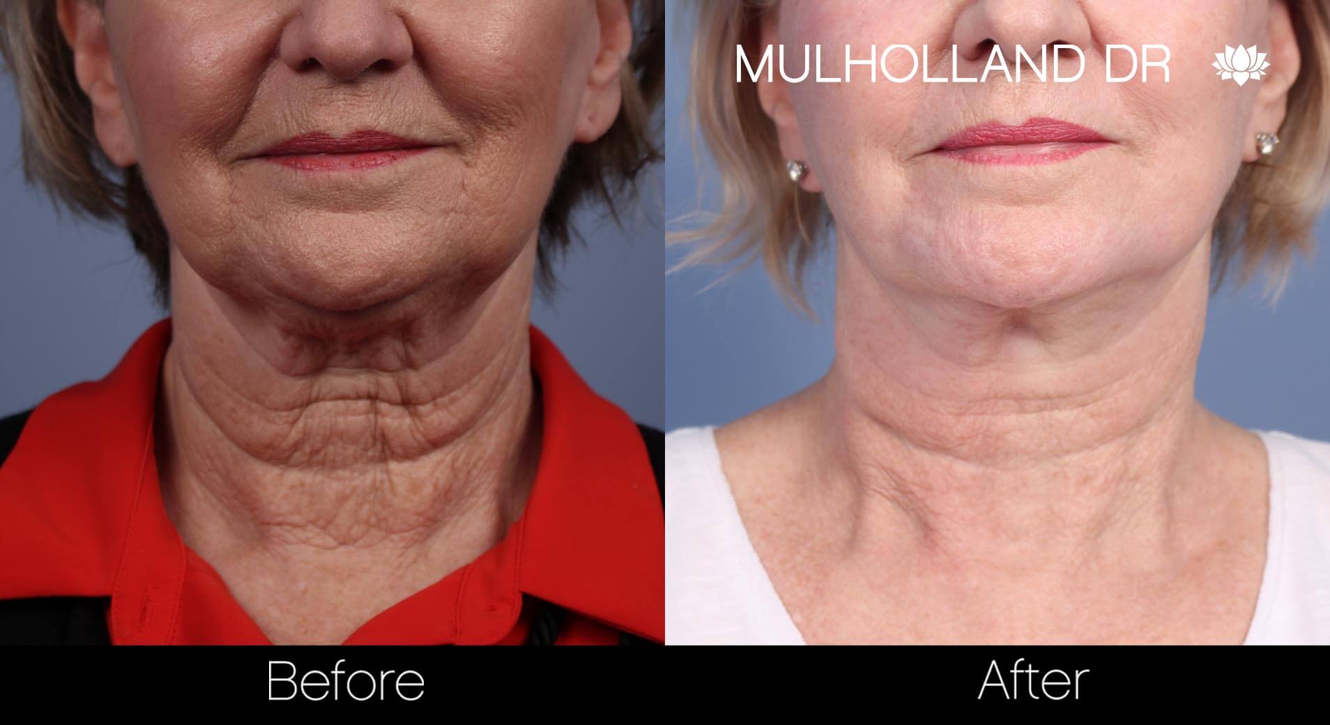 Fractora - Before and After Gallery – Photo 42