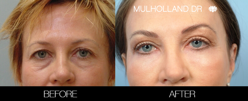 Fractora - Before and After Gallery – Photo 43