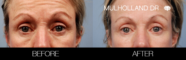 Fractora - Before and After Gallery – Photo 44
